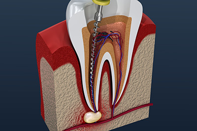 Root canals